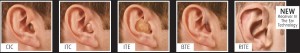Types of Hearing Aids